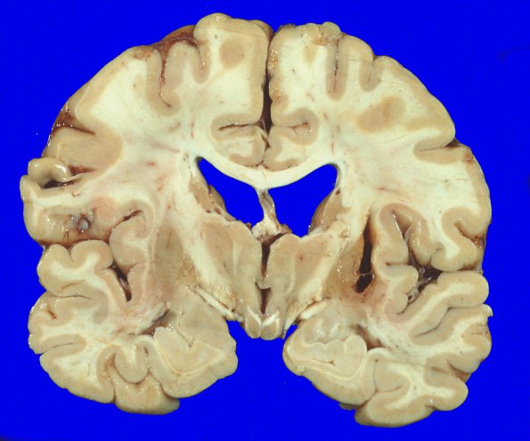 2A3 Meningioma, suprasellar (Case 2) 5