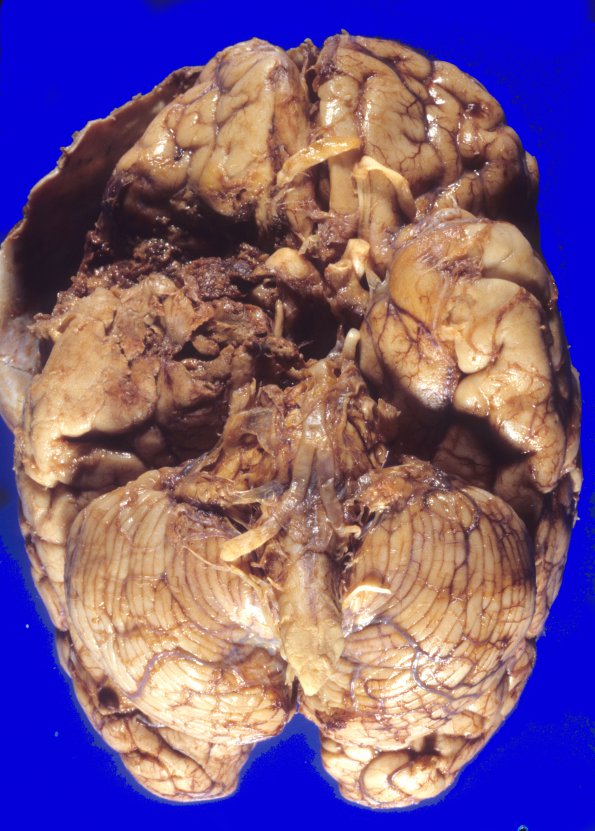 30A1 Meningioma, post surgical resection (Case 30) gross 2