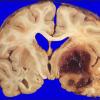 30A2 Meningioma, post surgical resection (Case 30) gross 1