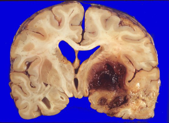 30A2 Meningioma, post surgical resection (Case 30) gross 1