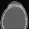 31A1 Meningioma & Hyperostosis (Case 31) CT 4 - Copy