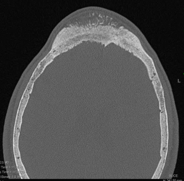 31A1 Meningioma & Hyperostosis (Case 31) CT 4 - Copy