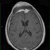 31A2 Meningioma & Hyperostosis (Case 31) T1 W 7 - Copy