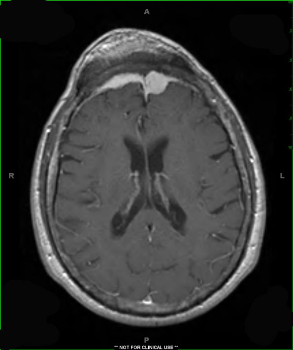 31A2 Meningioma & Hyperostosis (Case 31) T1 W 7 - Copy