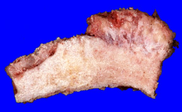 31B Meningioma & Hyperostosis (Case 31)_4