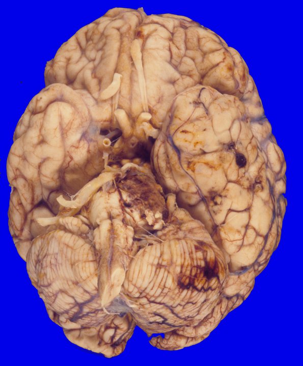 32A1 Meningioma removal, SP (Case 32) 2