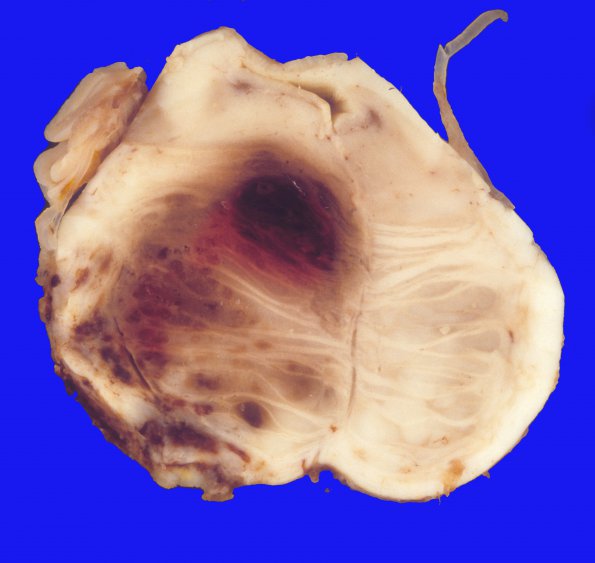 32A3 Meningioma removal, SP (Case 32) 1