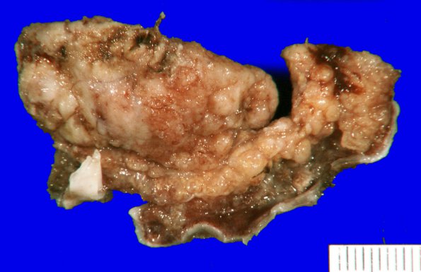 33A1 Meningioma with hyalinized vasculature (Case 33) Gross_2