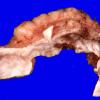 33A2 Meningioma with hyalinized vasculature (Case 33) Gross_7