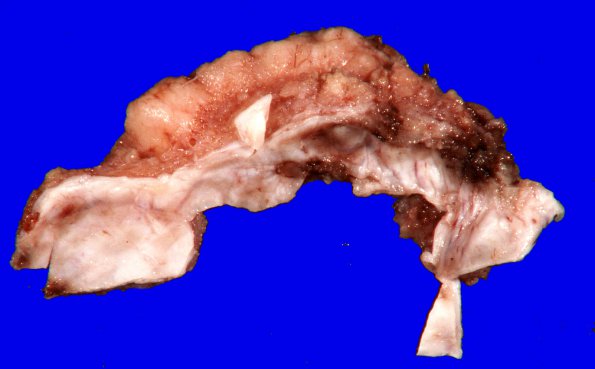 33A2 Meningioma with hyalinized vasculature (Case 33) Gross_7