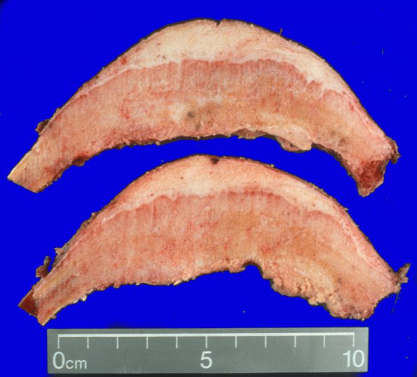 34A1 Meningioma, hyperostosis (AANP 1995-11)