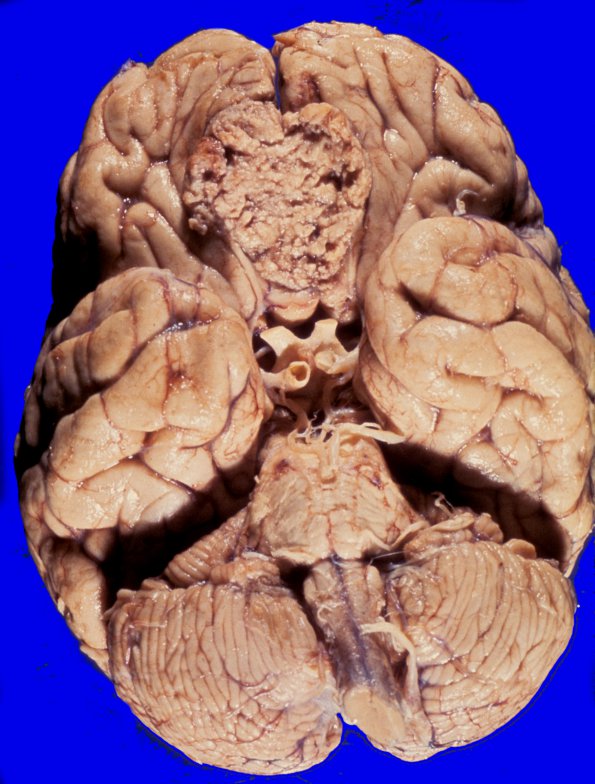 35A1 Meningioma (Case 35)