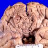 35A2 Meningioma (Case 35) 1