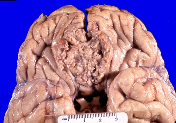 35A2 Meningioma (Case 35) 1