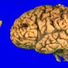 36 Meningioma (Case 36) Gross_1