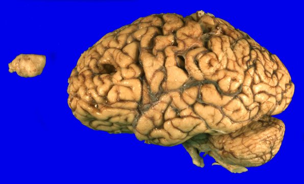 36 Meningioma (Case 36) Gross_1