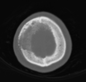 37A1 Meningioma (Case 37) - Copy