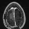 37A2 Meningioma (Case 37) T1W - Copy