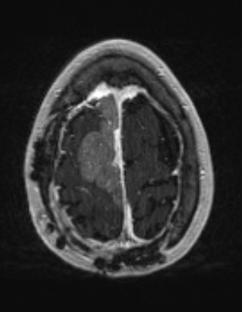 37A2 Meningioma (Case 37) T1W - Copy