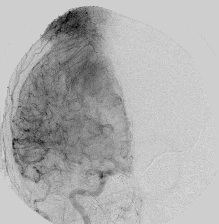 37A3 Meningioma (Case 37) MR Angiogram 1 - Copy - Copy