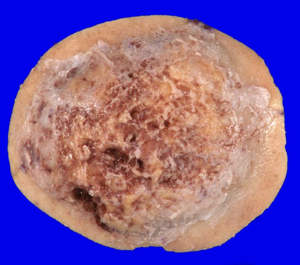 37B1 Meningioma (Case 37) Gross _1