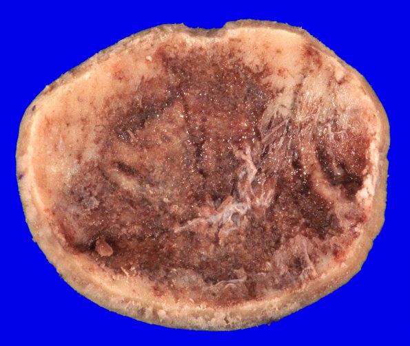 37B2 Meningioma (Case 37) Gross _2