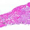 37C1 Meningioma (Case 37) H&E WM