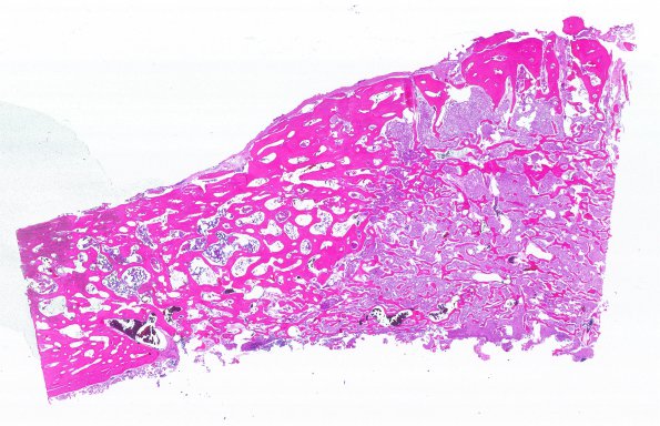 37C1 Meningioma (Case 37) H&E WM