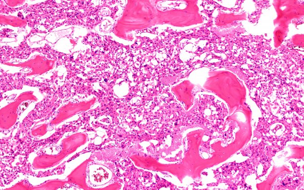 37C2 Meningioma (Case 37) H&E 10X