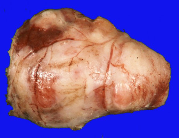 38A1 Meningioma (Case 38) 2