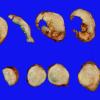 38A2 Meningioma (Case 38) 3