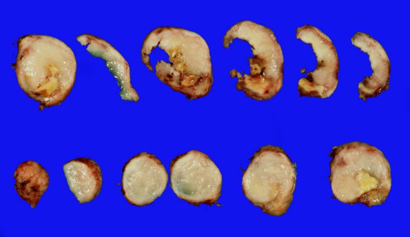 38A2 Meningioma (Case 38) 3