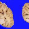 39A1 Meningioma (Case 39) 1