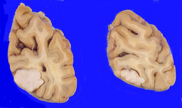 39A1 Meningioma (Case 39) 1