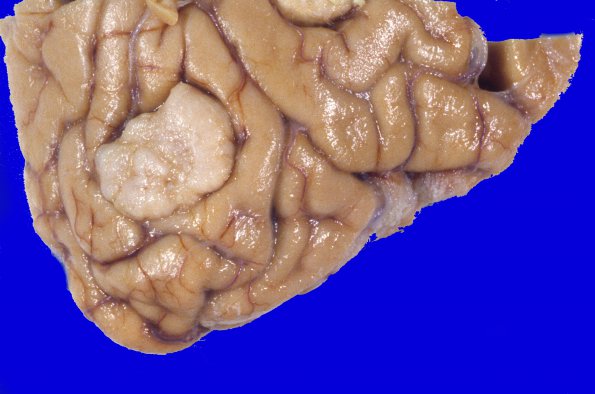 39A2 Meningioma (Case 39) 2