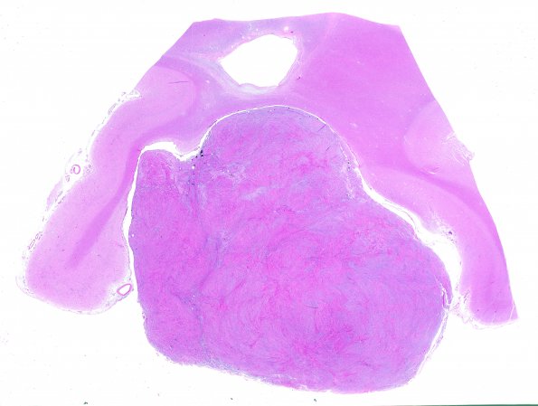 39B1 Meningioma (Case 39) Block 32 H&E WM