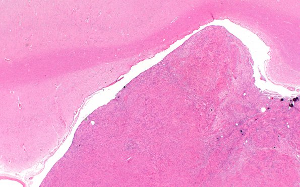 39B2 Meningioma (Case 39) Block 32 H&E 2X