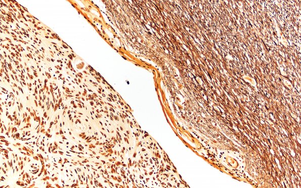 39B4 Meningioma (Case 39) Block 32 MBT 20X