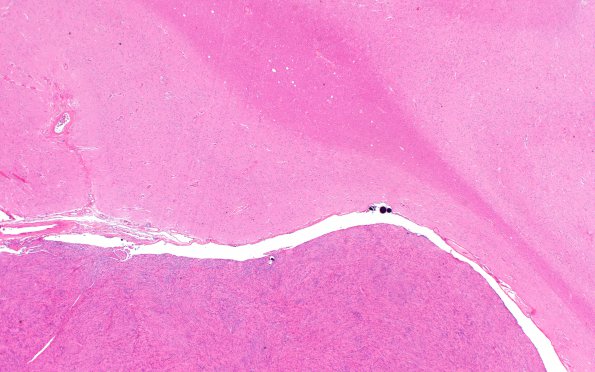 39C2 Meningioma (Case 39) H&E Block 33 H&E 2X