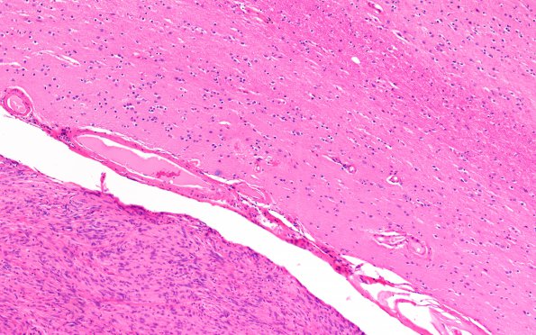 39C3 Meningioma (Case 39) H&E Block 33 H&E 10X