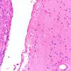 39C4 Meningioma (Case 39) H&E Block 33 H&E 20X