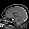 3A1 Meningioma (Case 3) T1 - Copy