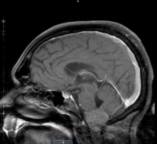 3A1 Meningioma (Case 3) T1 - Copy