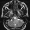 3A1 Meningioma (Case 3) T2 - Copy