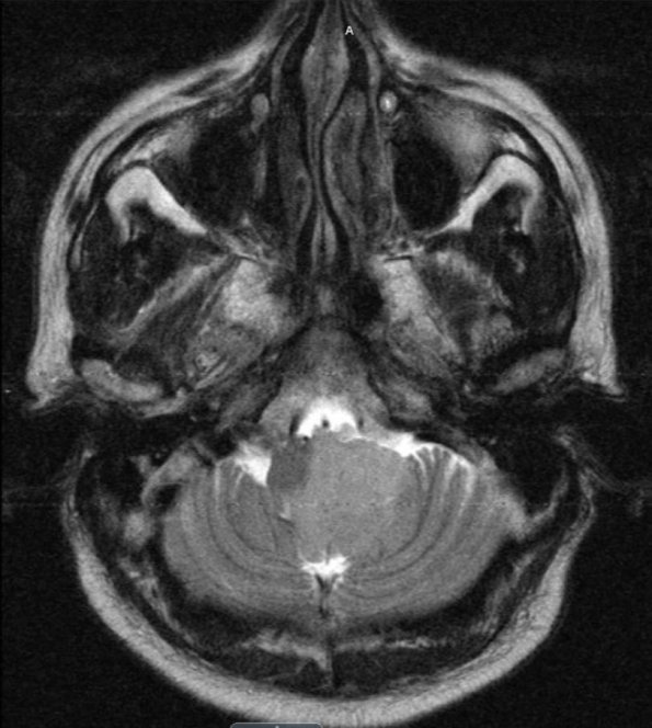 3A1 Meningioma (Case 3) T2 - Copy