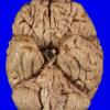 3B1 Meningioma (Case 3) gross 1