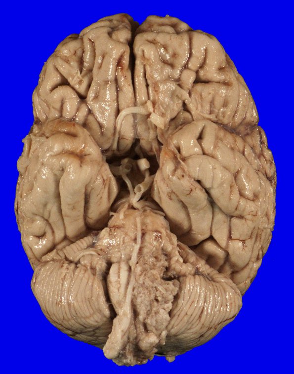 3B1 Meningioma (Case 3) gross 1