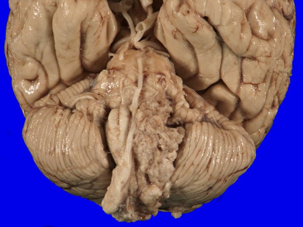 3B2 Meningioma (Case 3) gross 2