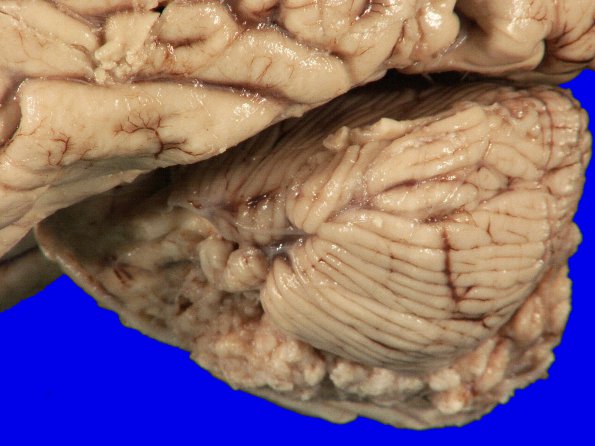 3B3 Meningioma (Case 3) gross 4