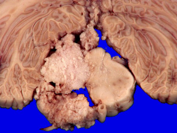 3B4 Meningioma (Case 3) gross 1_6